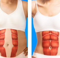 Упражнения для диастаза живота